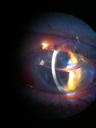 cornea