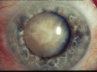 Cataract